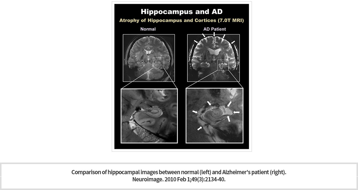 hippocampus anatomy sulcus coronal high resolution t1 mri